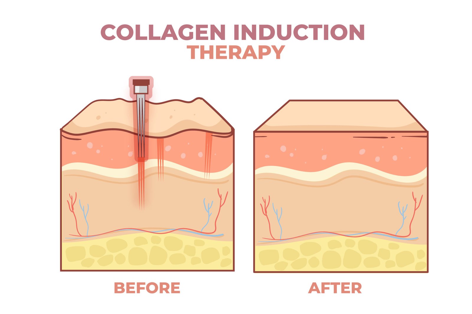 collagen for athletes